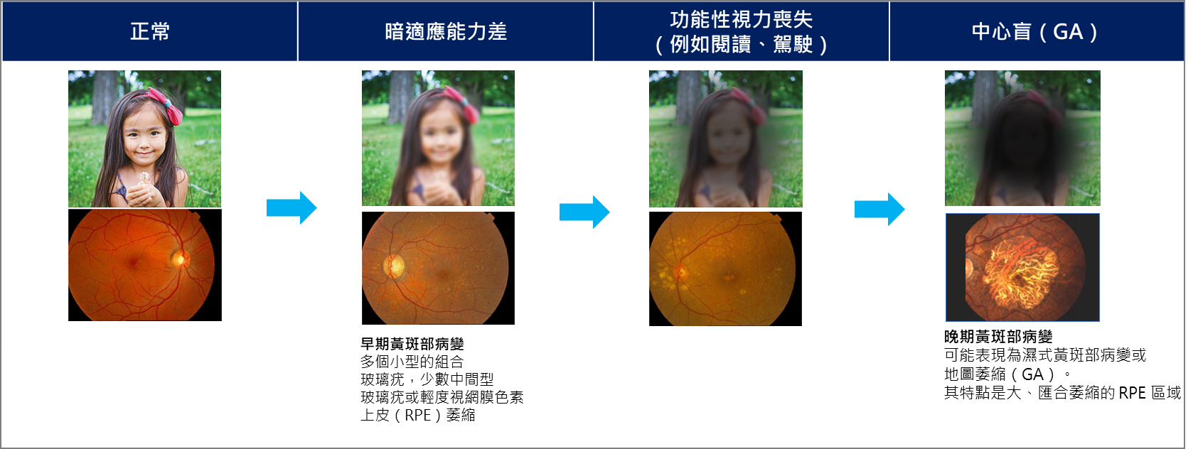 地圖狀萎縮（Geographic Atrophy, GA）